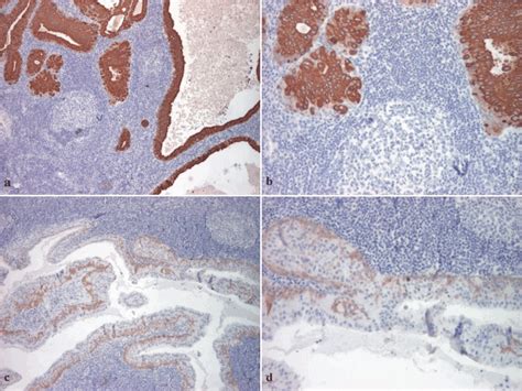 Warthin Tumor Ck Immunostain A B Ck Immunostain