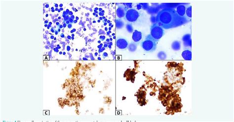 Figure 1 From Utility Of Immunocytochemistry In Differentiating Acinar Cell Carcinoma From