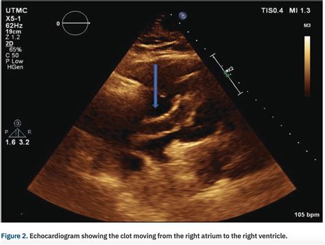 Clot In Transit” Percutaneous Or Surgical Approach