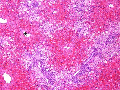 Diffuse Severe Coagulative Necrosis Of Hepatocytes Associated With