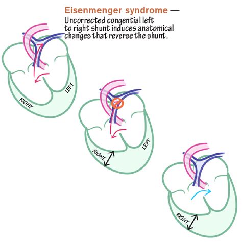 Embryology Glossary Congenital Cardiac Left To Right Shunts Ditki