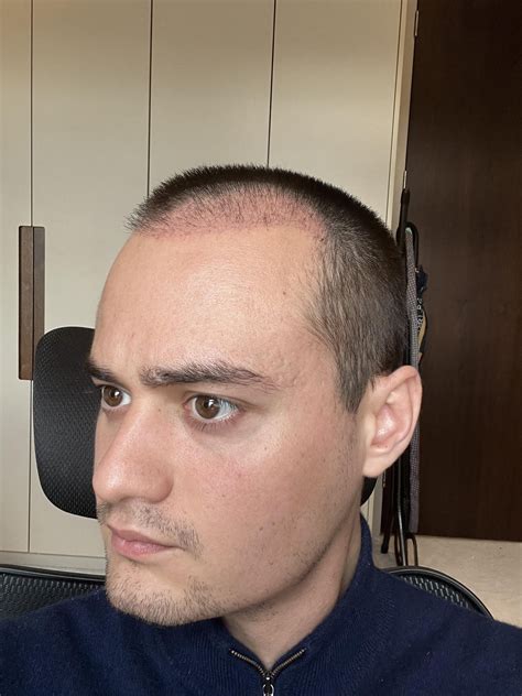 jidions hairline after a month : r/JiDion