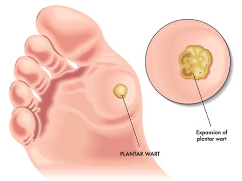 Common Foot Bumps and What they Mean | Chicago DPM