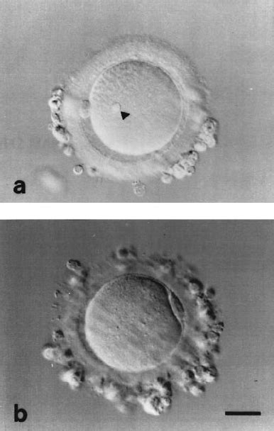 Morphologically Abnormal Human Oocytes A Inclusion In The Oocyte