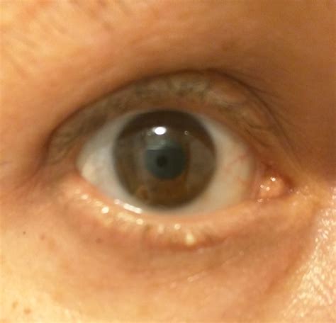 New cyst popping videos are trending on social media platforms 3