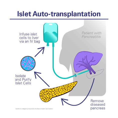 Pancreatectomy With Islet Cell Auto Transplant VCU Hume Lee