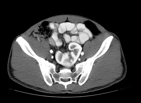 Renal Ectopia Ultrasound Wikidoc