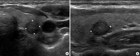 Thyroid Cancer Ultrasound