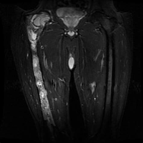 Mazabraud Syndrome Radiology Case Radiopaedia Org Radiology