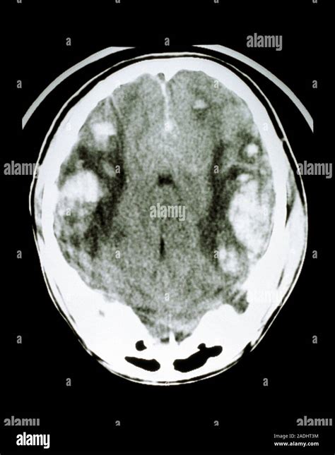 Lesiones En La Cabeza Una Tomografía Computarizada Del Cerebro Humano