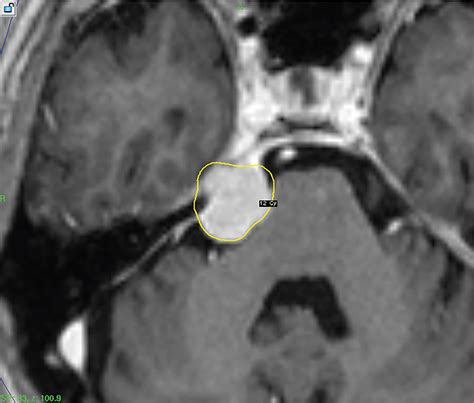 Trigeminal neuralgia due to petroclival meningioma – upfront ...