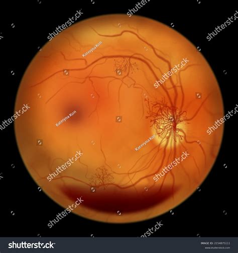 Proliferative Diabetic Retinopathy Illustration Showing Preretinal