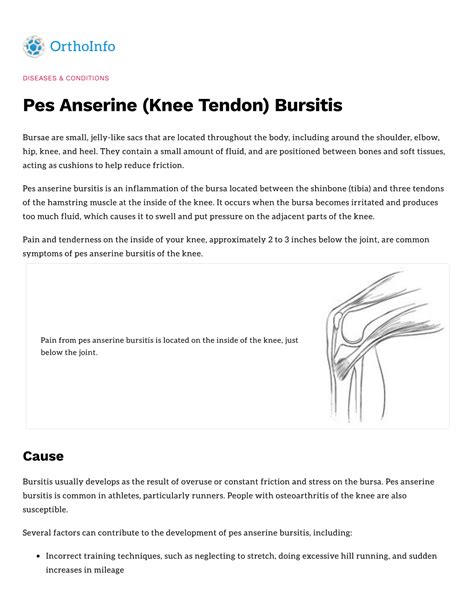 Pes Anserine (Knee Tendon) Bursitis - DocsLib