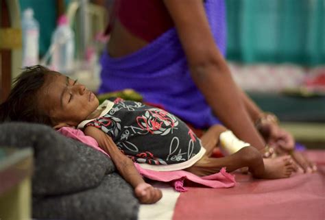 100 In Indonesias Papua Feared Dead From Malnutrition Measles