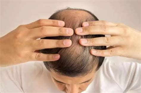 Penyebab Rambut Rontok Pada Pria Lengkap Cara Mengatasinya Sonora Id