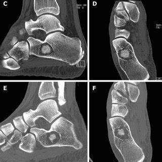 Serial computed tomography evaluation of os calcis lesion. A and B:... | Download Scientific Diagram