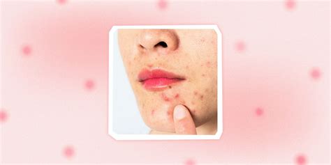 How to Get Rid of Pimples on Lips, According to Board-Certified Dermatologists