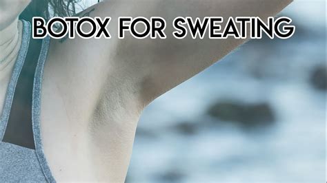 Botox For Sweating Youtube