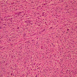 Typical histological characteristics of a high‐grade leiomyosarcoma ...