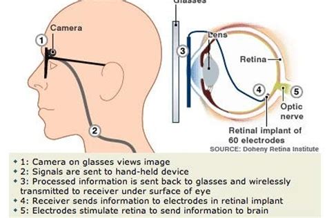 The Bionic Eye Approaches The Next Generation Of Retinal Implants