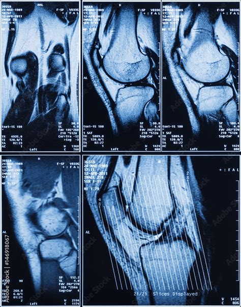 MRI of Human Knee for Medical Diagnosis Stock Photo | Adobe Stock