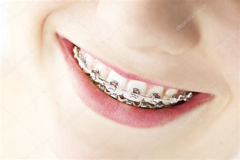 Smile with braces — Stock Photo © elenathewise #11552083