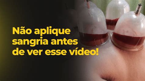 Sangria Ventosa Guia prático de aplicação da Técnica de Sangria