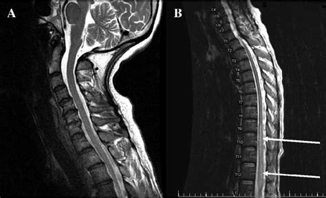 T2 Weighted Magnetic Resonance Image Of The Cervical A And Thoracic