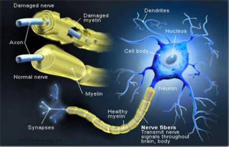 Chronic Inflammatory Demyelinating Polyneuropathy (CIDP) - Physiopedia