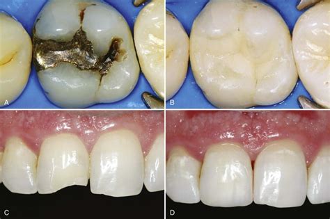 Composite Restorations | Family Dentistry of Lowell