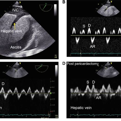 A Transgastric Caval View Showing A Dilated Inferior Vena Cava Ivc