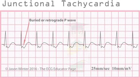 Coarse V Fib Ecg - theme-arabic