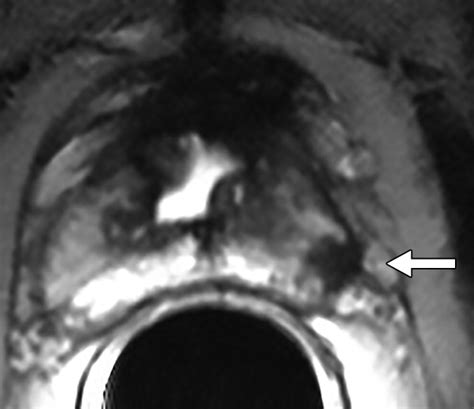 Apparent Diffusion Coefficient Value And Ratio As Noninvasive Potential