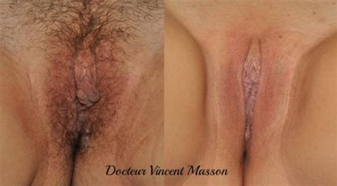 Photos Before And After Intimate Surgery Docteur Masson Vincent