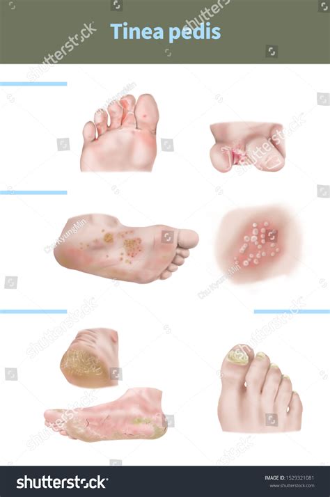 Medical Illustration Explain Tinea Pedis 스톡 일러스트 1529321081 Shutterstock