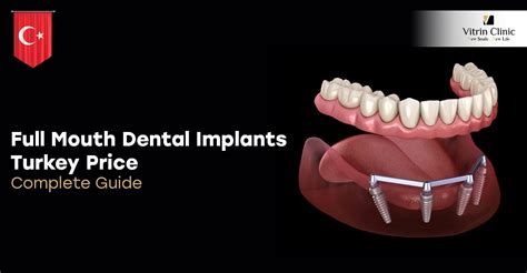 discover   full mouth dental implants turkey price vitrin clinic