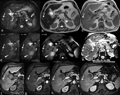 Is Magnetic Resonance Imaging Of Hepatic Hemangioma Any Different In