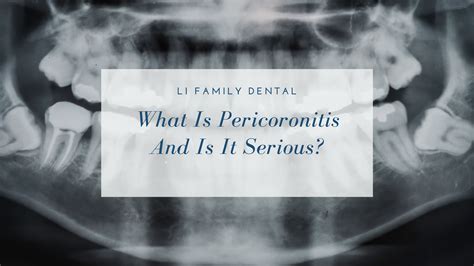 pericoronitis explained symptoms treatment  care tips