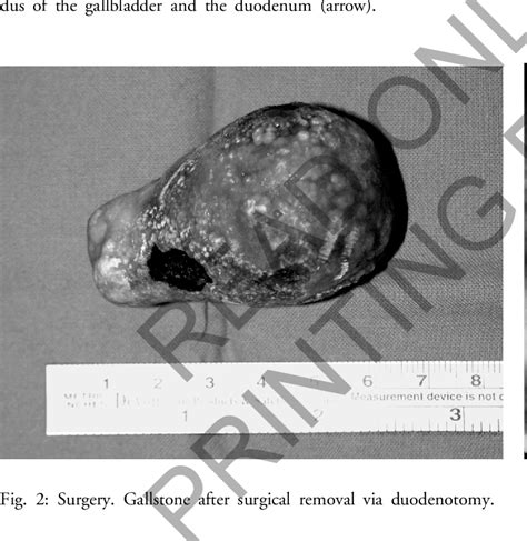 Figure 2 From Endoscopic Versus Surgical Treatment For A Rare Form Of