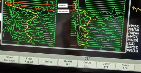 Uses Of Compressed Spectral Array In Intensive Care Paediatric