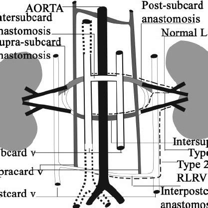 A Coronal Diagram Shows Embryological Development Of The Renal Veins