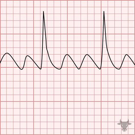 Atrial Flutter Ecg Stampede