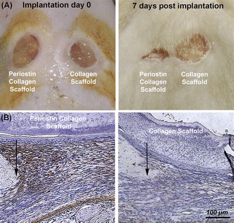 Wound Healing And Fibrosis A Contrasting Role For Periostin In Skin