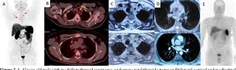 PDF Diagnostic Efficiency Of 68Ga DOTATATE PET CT As Compared To