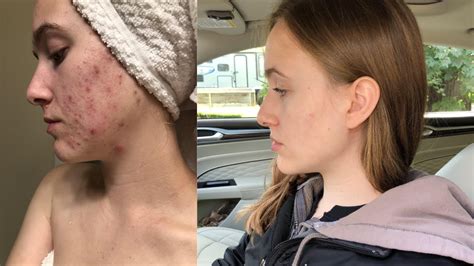 How I Actually Cleared My Cystic Acne Emotional Youtube