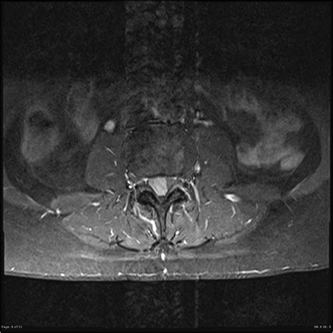 Clear Cell Meningioma Of The Lumbar Spine Image Radiopaedia Org