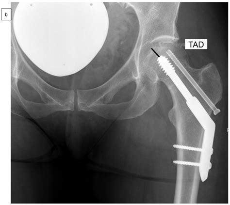 Medicina Free Full Text Internal Fixation Of Garden Type Iii