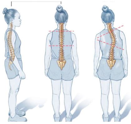 Semana 13 LA ESCOLIOSIS COLUMNA DESVIADA Sanatrix Clínica