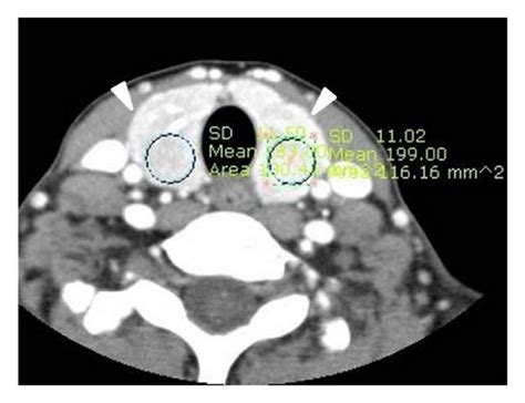 Non Hashimoto Lymphocytic Thyroiditis Designated “3 Or More” Ct Download Scientific Diagram