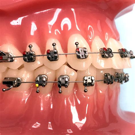 Orthodontie Bracket Metall Agility G H Orthodontics